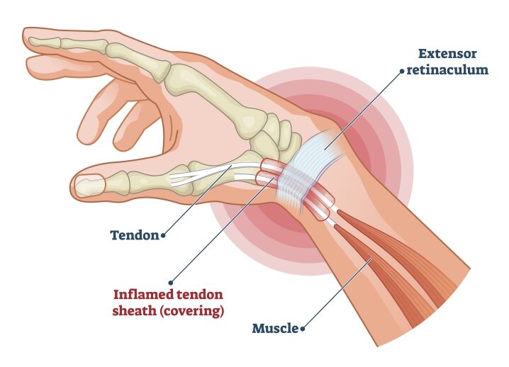 picture of wrist with inflamed de quervains tenosynovitis