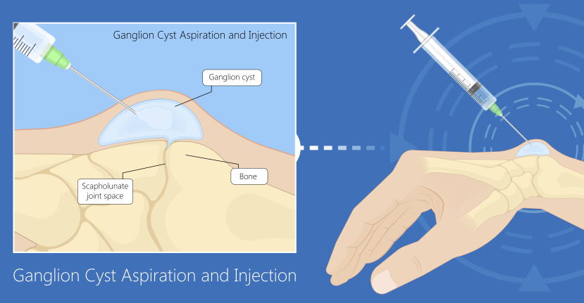 ganglion cyst diagram