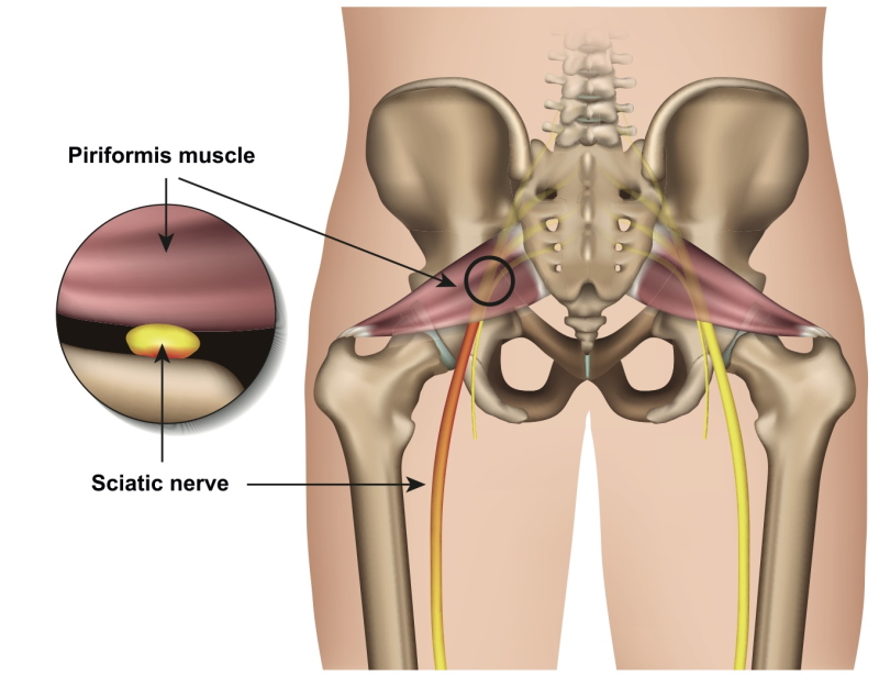 piriformis syndrome which could mimic proximal hamstring tendinopathy
