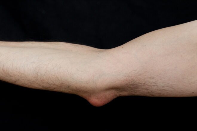 Elbow bursitis: what is it and how to treat it - Sport Doctor London