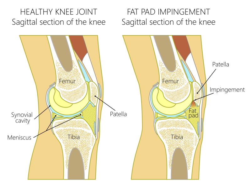 Fat on sale pad impingement