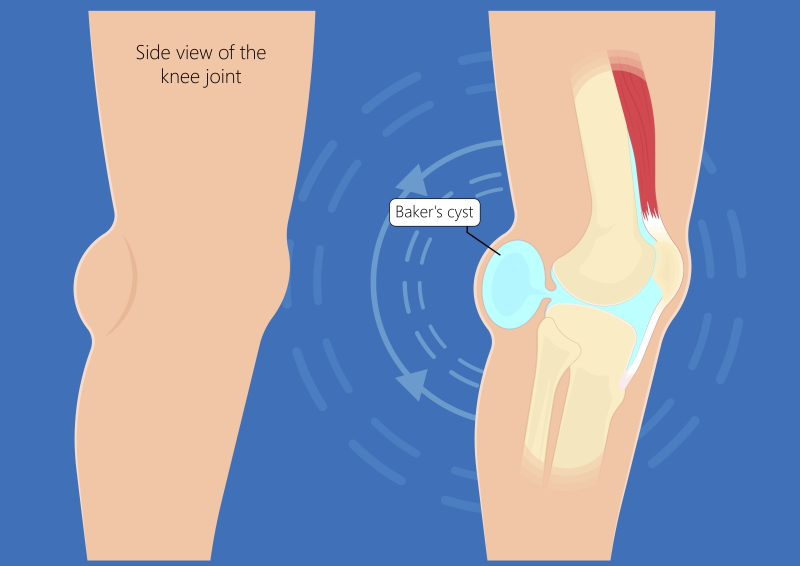 Pain Behind Knee What Should You Do Sport Doctor London