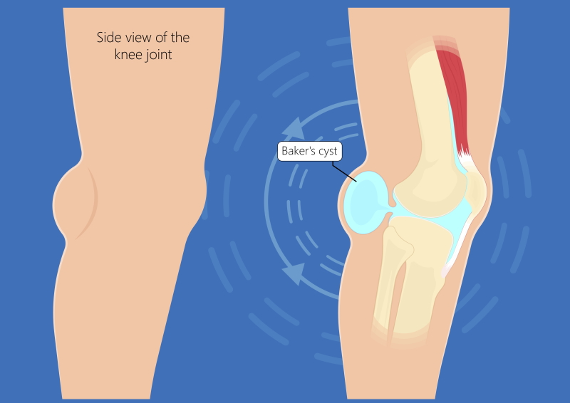 Pain Behind The Knee (posterior Pain) Health Information Bupa UK