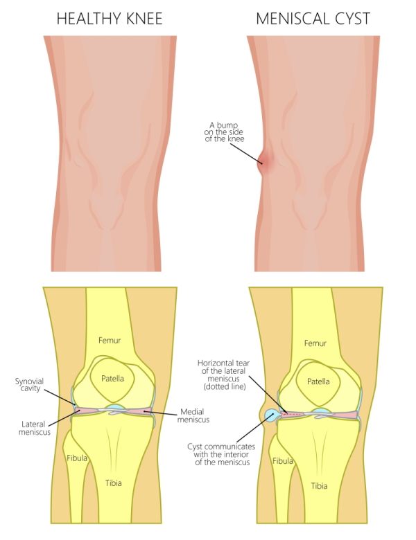 osteoarthritis knee lump)