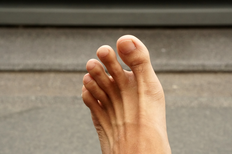 Little Toe Hurts? Four Things to Know About Pinky Toe Pain