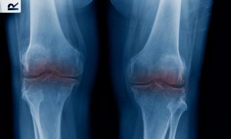X-ray showing no cartilage in knee - can osteoarthritis be reversed
