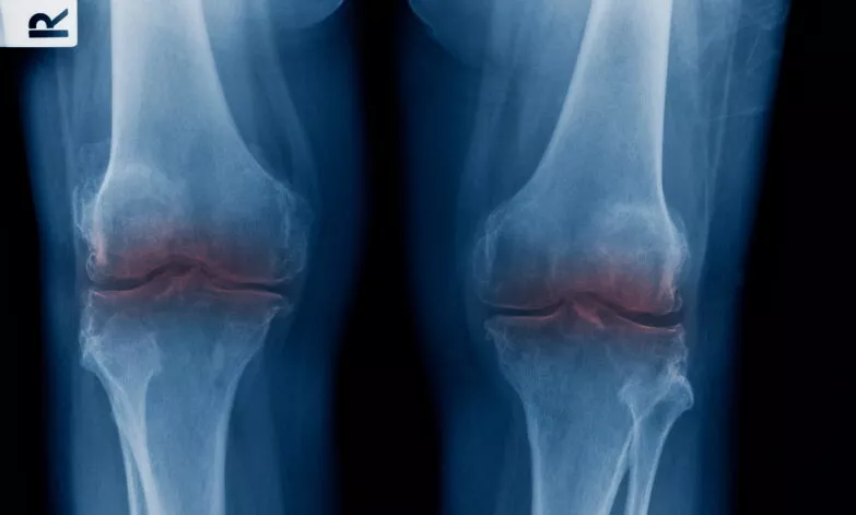 X-ray showing no cartilage in knee - can osteoarthritis be reversed