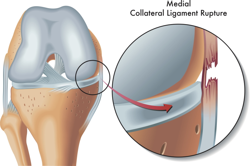 Medial collateral ligament or MCL injury of the knee: what to do