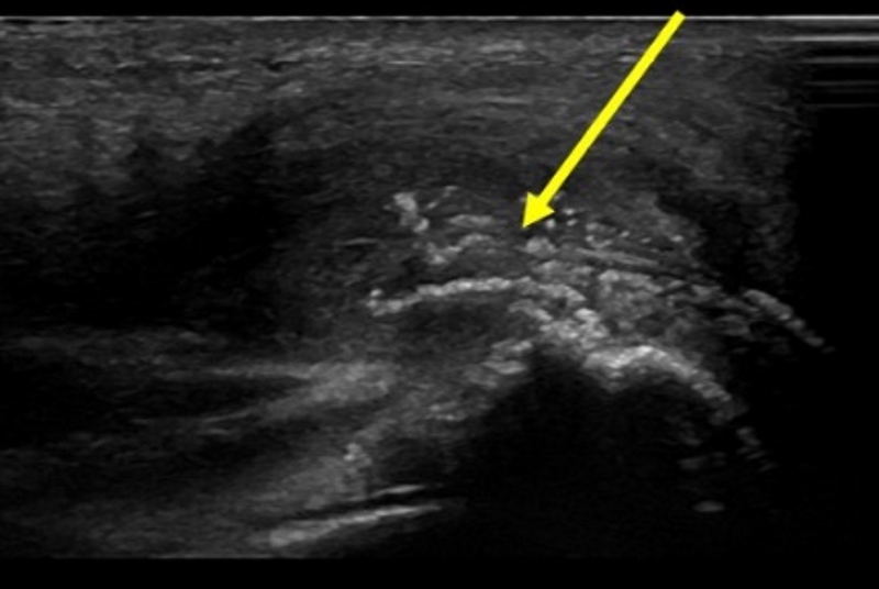 triceps tendonitis on ultrasound