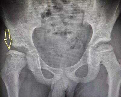 Hip Apophysitis | Traction Apophysitis in Teenagers - Sport Doctor London