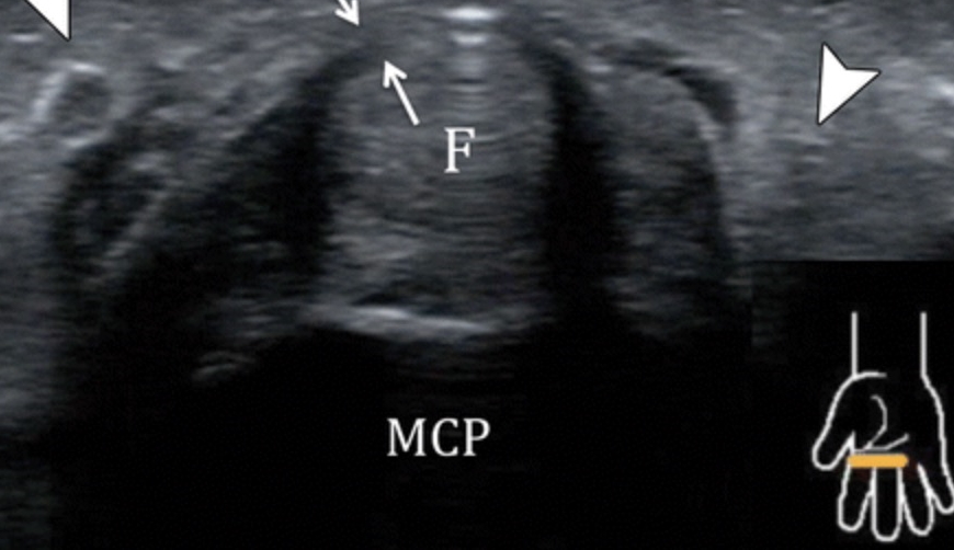 trigger finger release under ultrasound