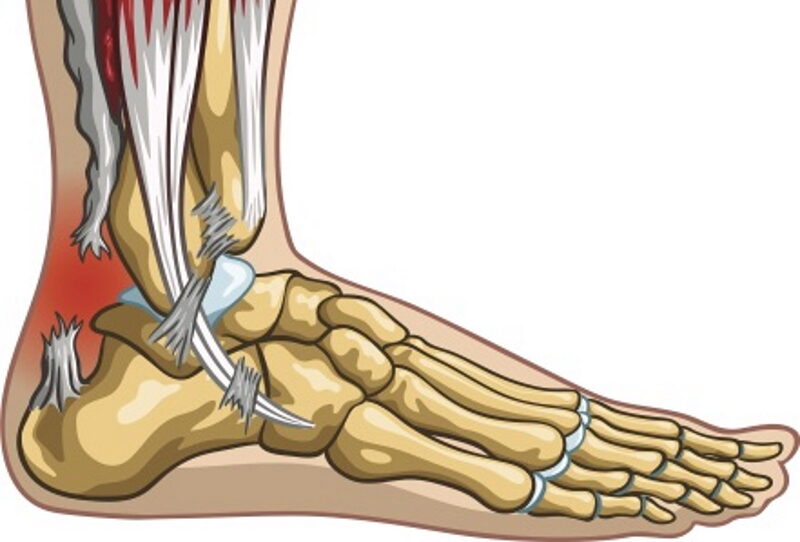 Achilles tendon clearance rupture pain