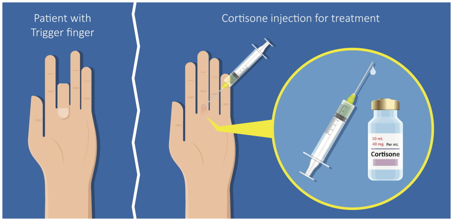 trigger finger injection using cortisone