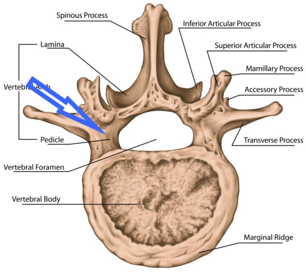 painful-pars-defect-a-common-cause-of-low-back-pain-in-the-young