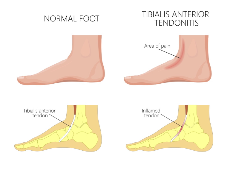 tibilais anterior tendonitis picture
