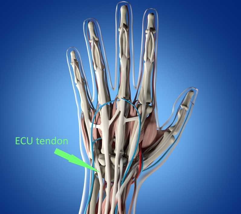 ECU Tendonitis: The Common Wrist Injury Explained - Sport Doctor London