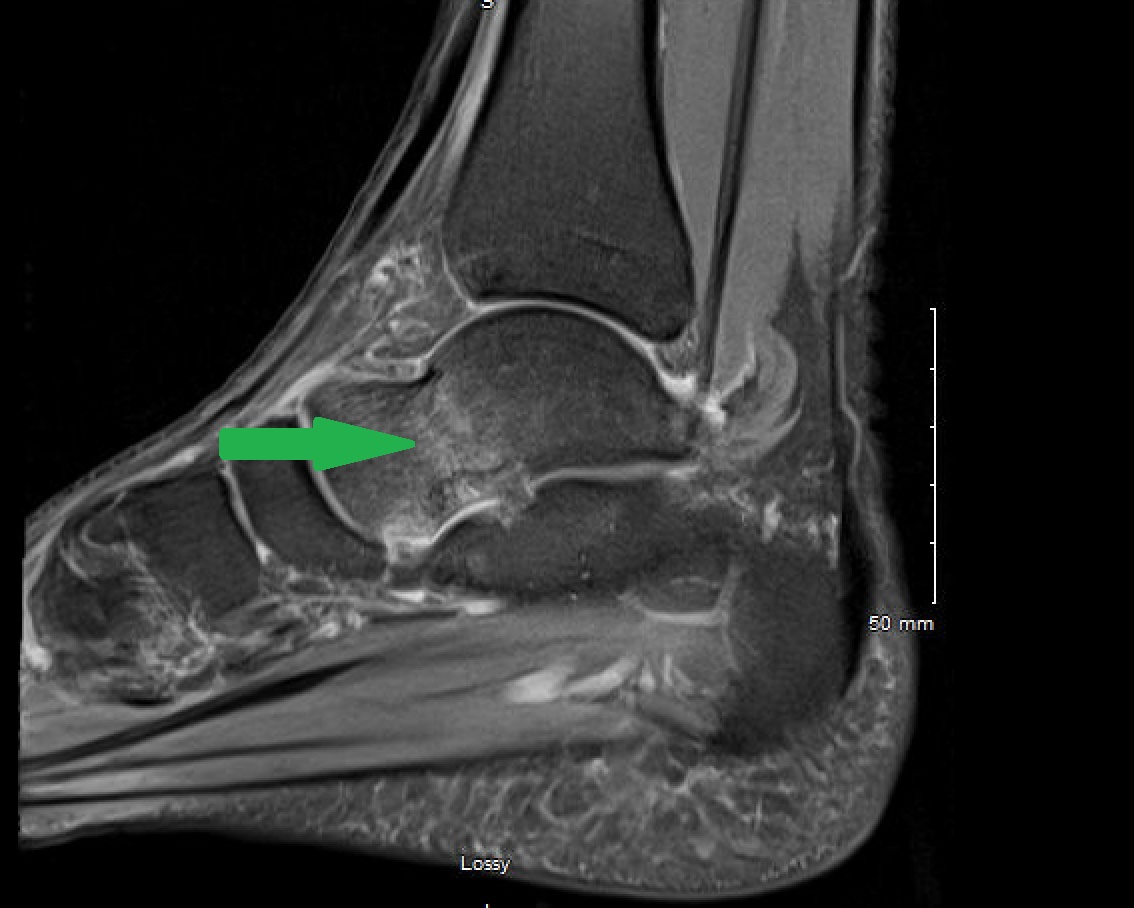 Stress Fracture In Talus Symptoms And Treatment Sport Doctor London Stress Fracture In Talus Symptoms And Treatment Sport Doctor London