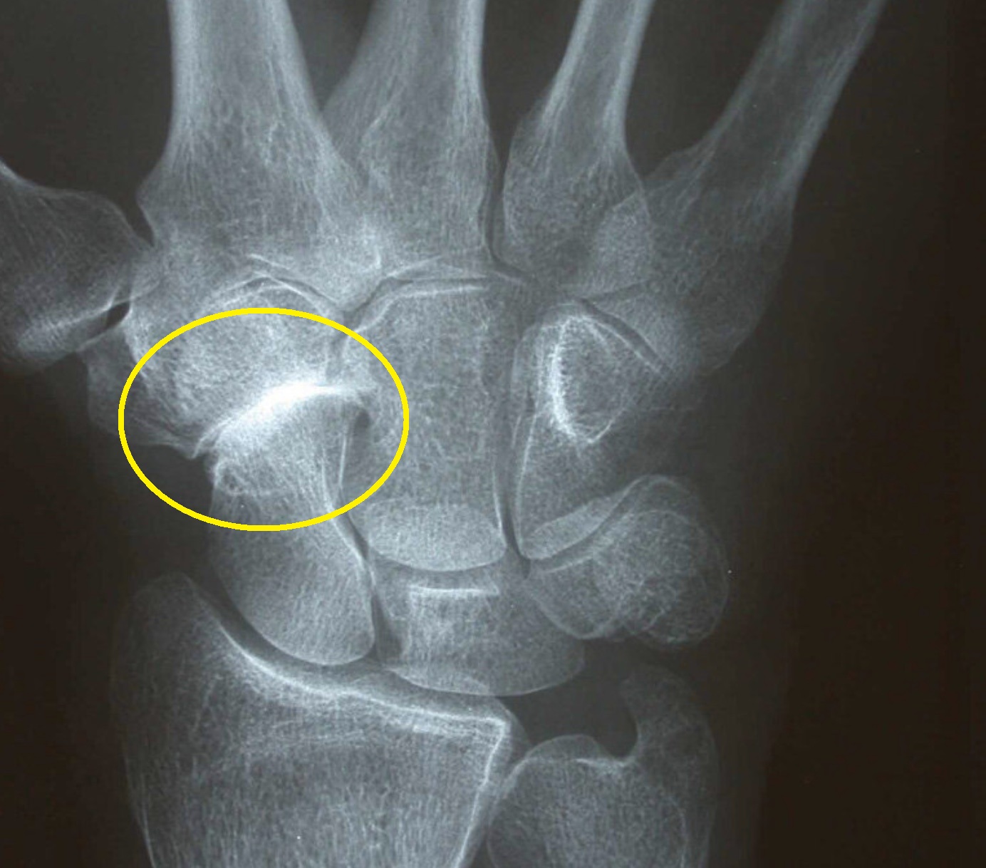 Op Wg Rhiz Und Stt Arhtrose Rhizarthrose Symptome bungen OP 