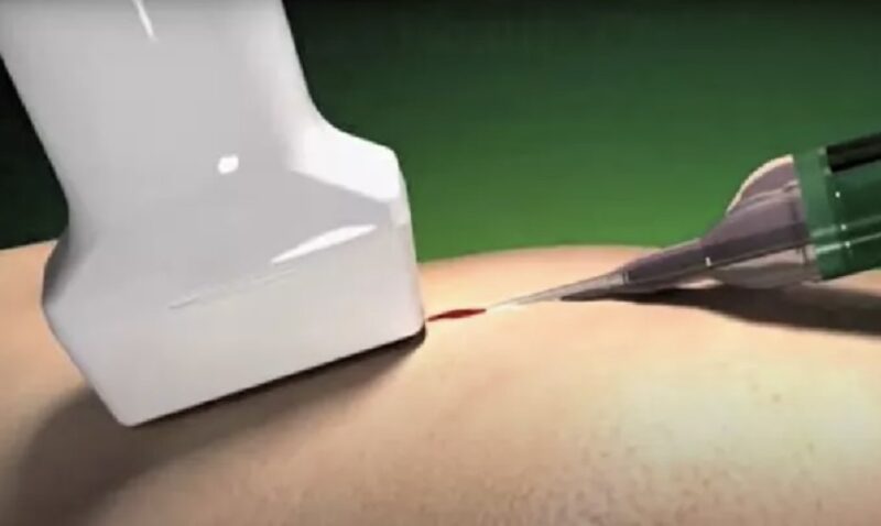 Tenex Procedure: Everything You Need to Know - Sport Doctor London