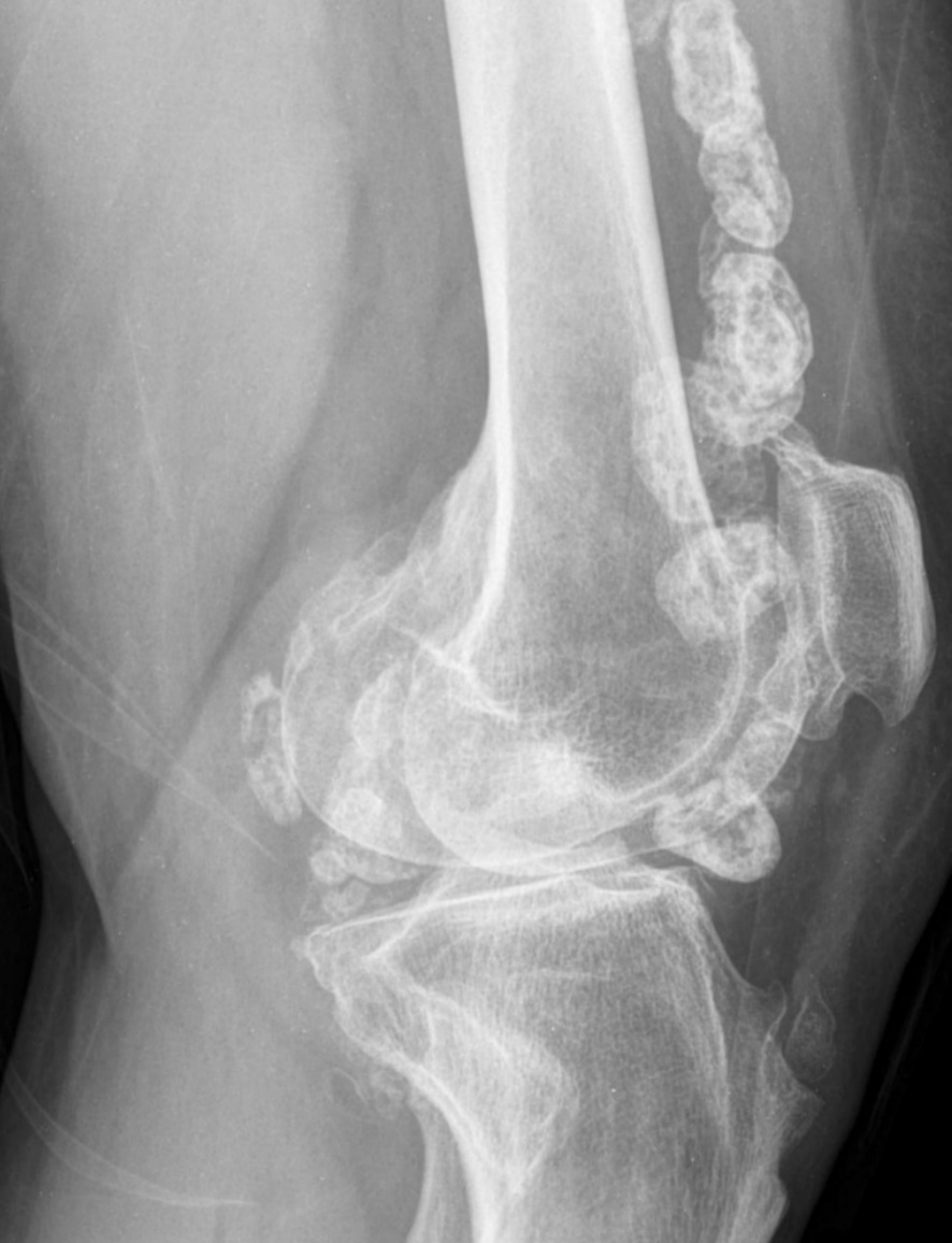 Synovial,Chondromatosis,Lateral,Knee,Xray knee joint with calcific loose bodies due to synovial chondromatosis