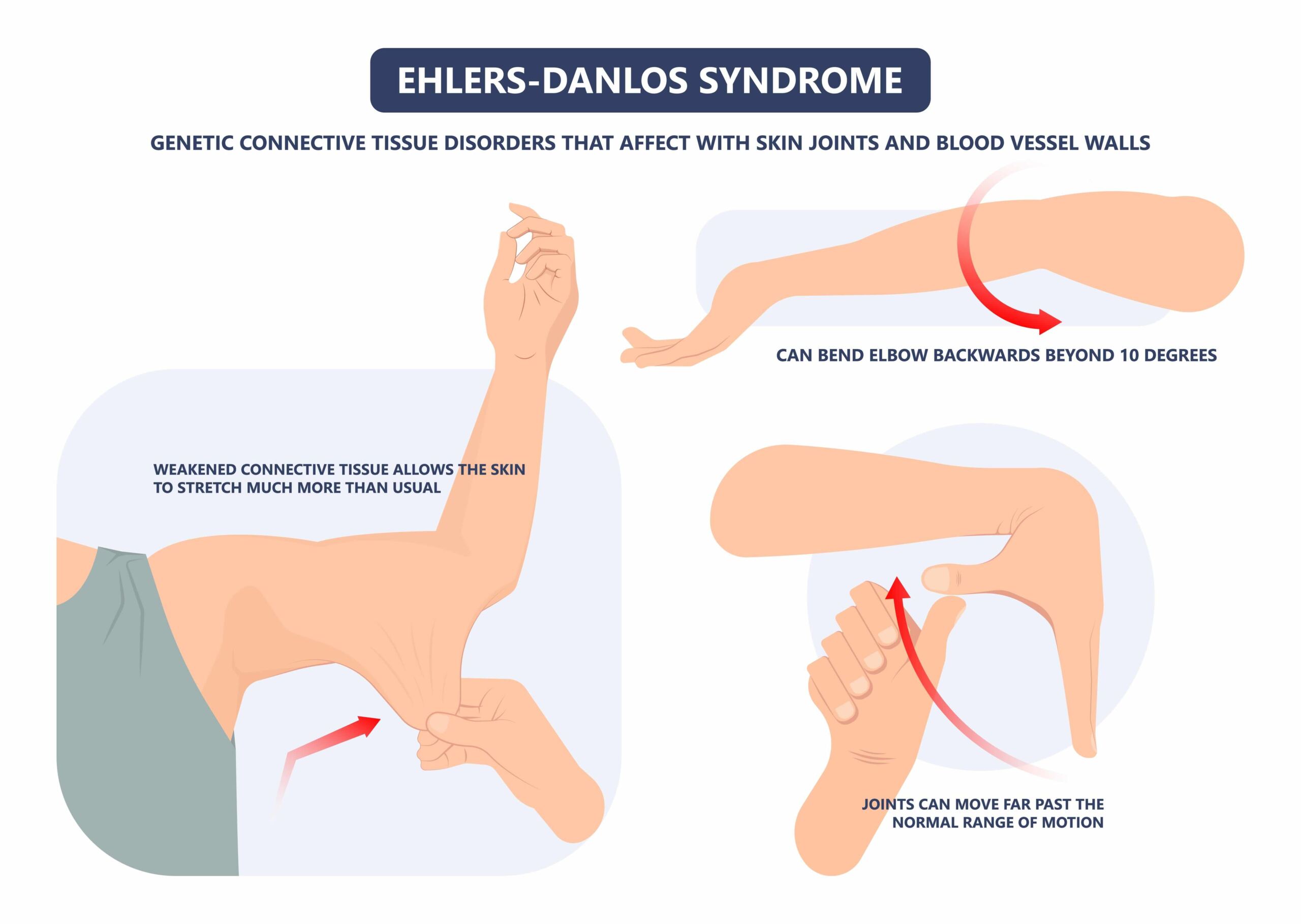 shutterstock_1887487984 signs of EDS