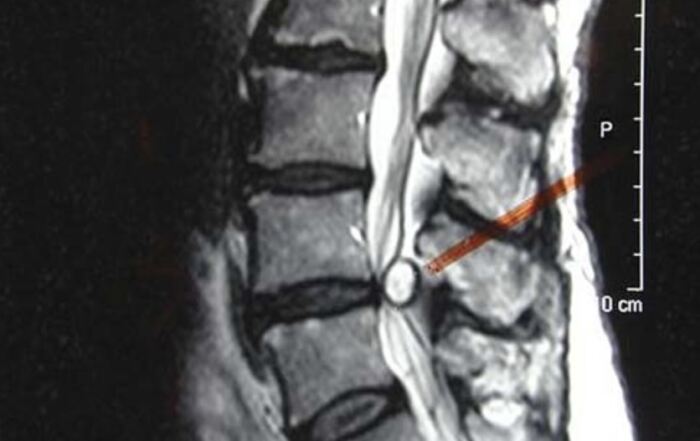mri showing synovial cyst lumbar spine