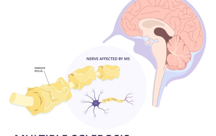 multiple sclerosis (MS) can cause early signs similar to sports injuries