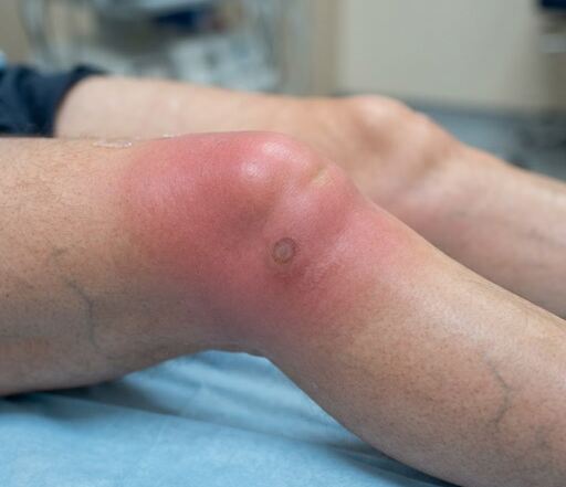 young male with septic arthritis due to gonorrhea of the knee