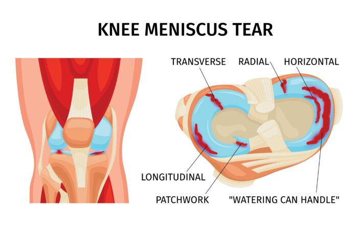 knee joint anatomy showing meniscus root tear and other meniscal tears