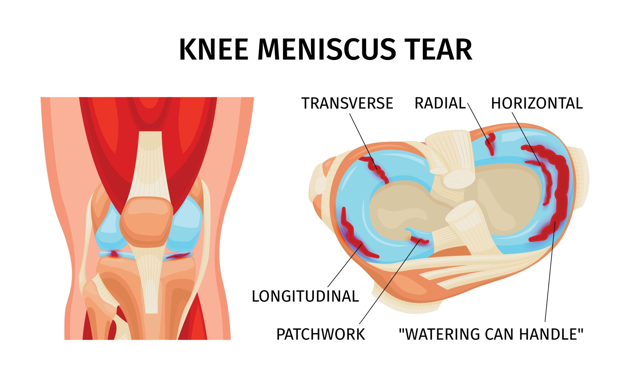 knee joint anatomy showing meniscus root tear and other meniscal tears